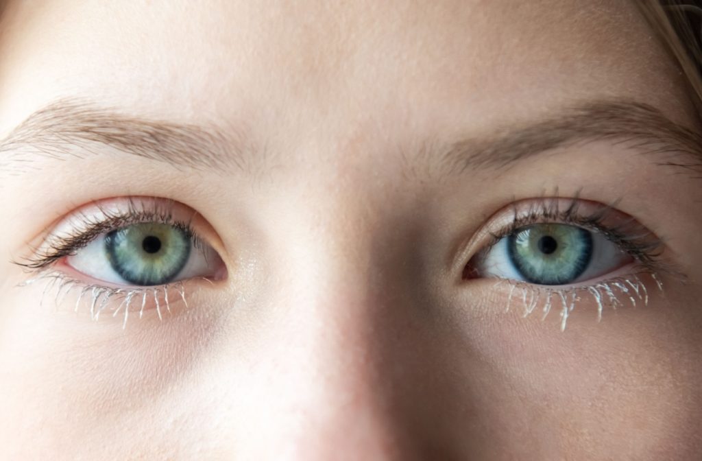 A close-up of a pair of blue-green eyes, with the eyelashes covered in a white dandruff-like substance that's indicative of blepharitis.